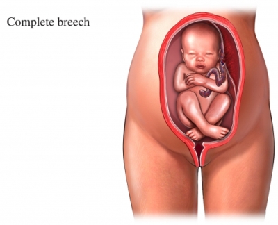 وضع المقعدة breech presentation