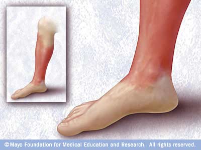 cellulitis التهاب خلوي