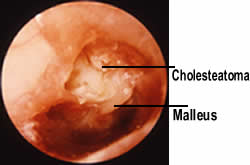 cholesteatoma