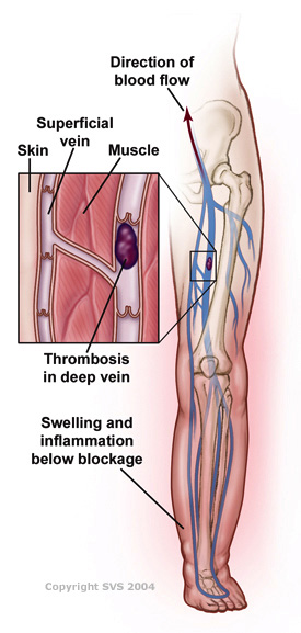 التجلّط الوريدي العميق Deep vein thrombosis