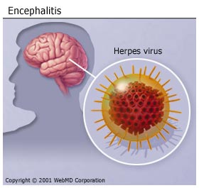 encephalitis