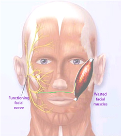 facial palsy