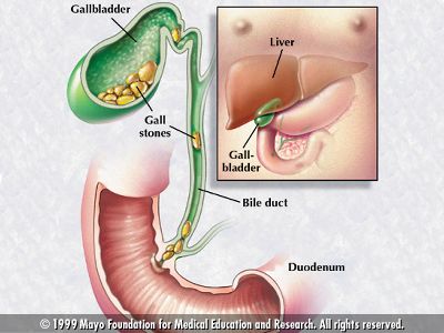 gallstone الحصوات المرارية