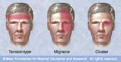 headache types انواع الصداع