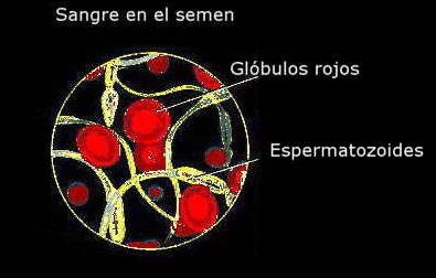 hemospermia