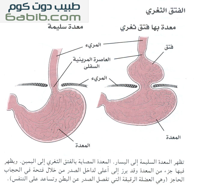 فتق ثغري hiatal hernia