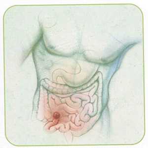 تفميم اللفائفي Ileostomy