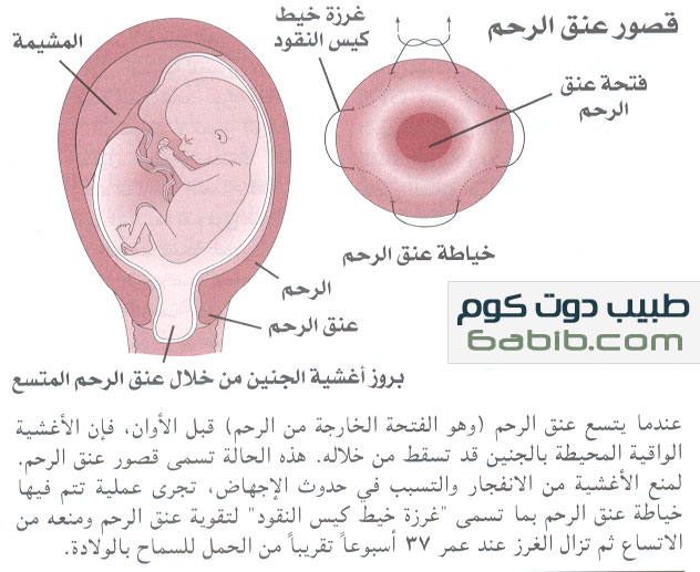 ضعف عنق الرحم incomplete cervix