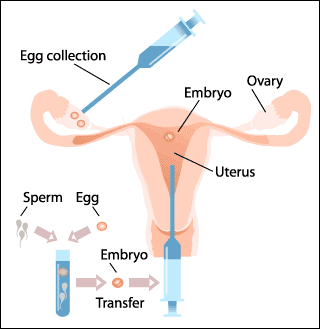 ivf اطفال الانابيب