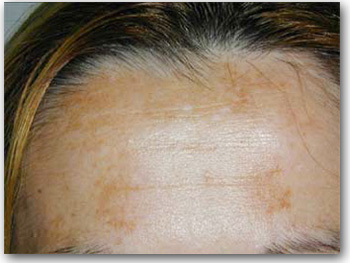 melasma