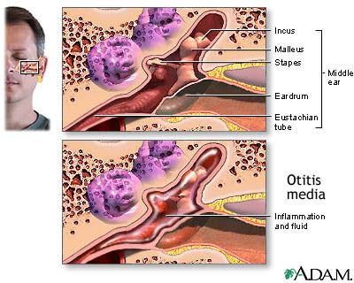 otitis media