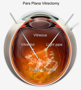 pars_plana_vitrectomy.jpg