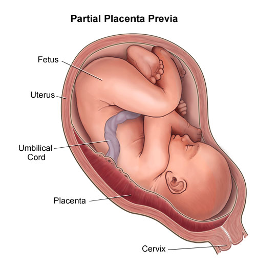 المشيمة المتقدمة جزئيا partial placenta previa 