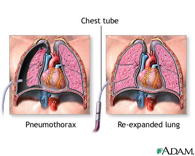 pneumothorax الاسترواح الصدري، الصدر المثقوب