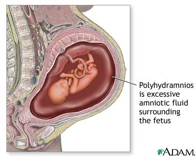 زيادة أو كثرة السائل الأمنيوسي polyhydramnios