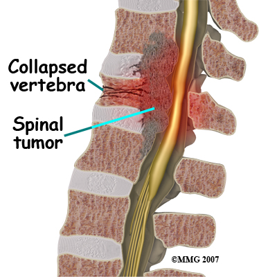 spinal tumor