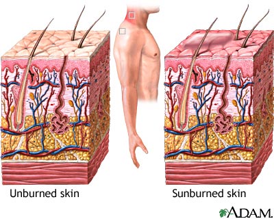 sunburn الحروق الشمسية، لفح الشمس