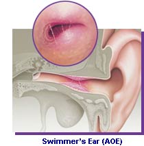 swimmers ear