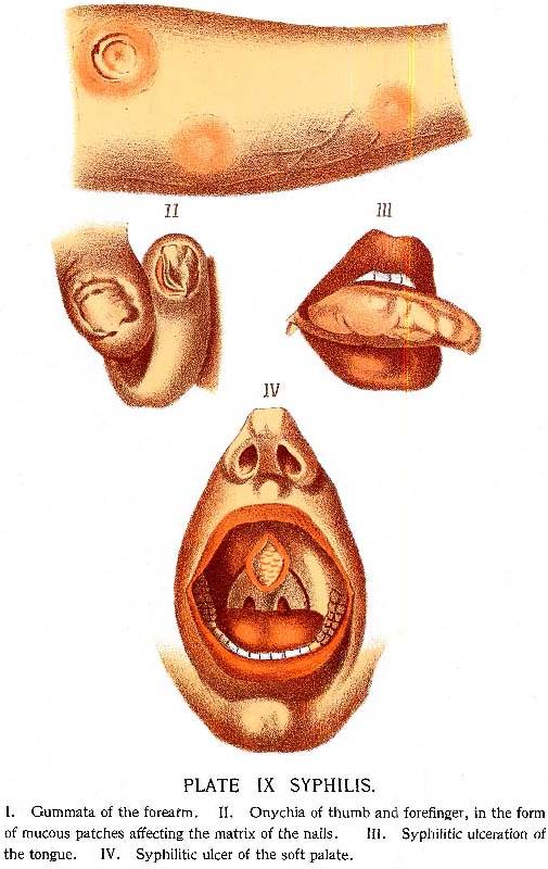 syphilis الزهري، السلفس