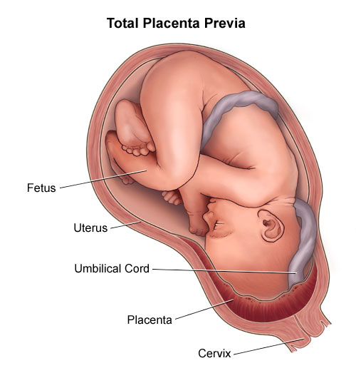 المشيمة المتقدمة الكاملة أو الكلية total placenta previa
