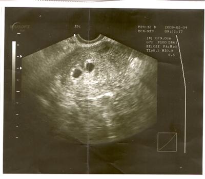 صورة بالموجات فوق الصوتية لتوأم عمرهما 4 أسابيع Ultrasound twins 4 weeks