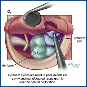 tympanoplasty.jpg