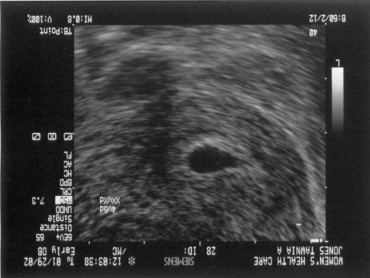 صورة بالموجات فوق الصوتية لجنين عمره 4 أسابيع Ultrasound 4 weeks - the sac