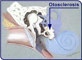 تصلب الأذن otoscelerosis