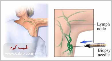 Lymph%20Node%20Biopsy%20copy.jpg