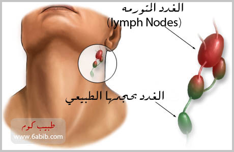 Swollen%20glands.jpg