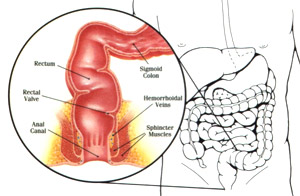 UlceProctitis.jpg