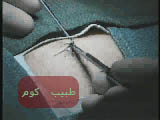 incision2%20copy.jpg