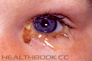 إلتهاب الملتحمة Conjunctivitis