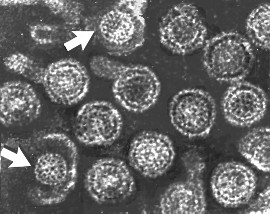 التهاب الكبد الفيروسي ب   Hepatitis B