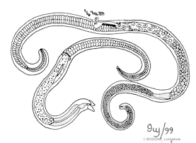 داء التريكينيلا Trichinosis