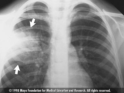 Chest X-ray showing pneumonia