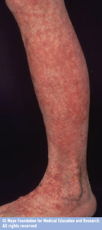 Petechiae