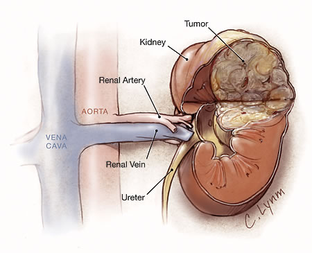 سرطان الكلية Kidney cancer