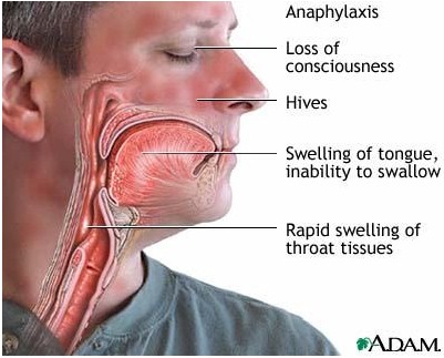العوار (صدمة الحساسية) Anaphylaxis
