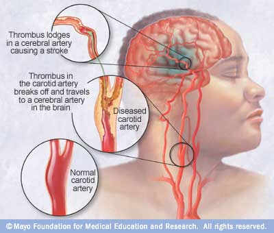 Ischemic stroke occurs when a blood clot (thrombus) blocks or plugs an artery leading to the brain. A blood clot often forms in arteries damaged by buildup of plaques (atherosclerosis). It can occur in the carotid artery of the neck as well as other arteries