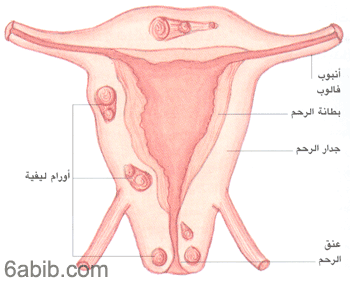 الاماكن التي تتواجد فيها الاورام الليفية