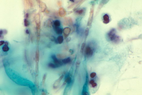 Candida albicans in vaginal smear