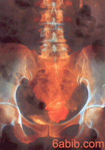 صورة بالاشعة السينية لرحم يظهر فيه ورم ليفي على شكل كتلة برتقالية في وسط الصورة